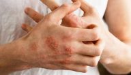 “مرض منتشر احذر منه” أسباب الإكزيما وطريقة اكتشافه وعلاجه