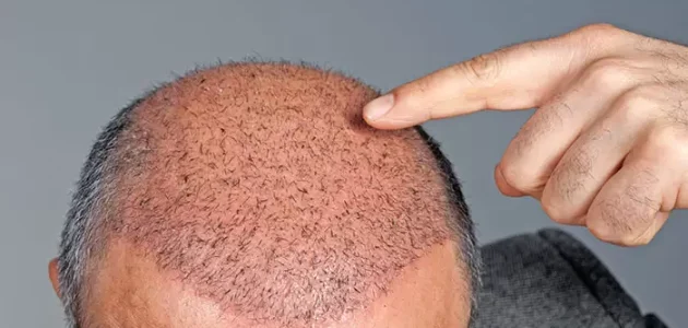 طريقة مفعولها كالسحر | بديل زراعة الشعر طبيعي وآمن بتكلفة بسيطة جدًا!! 1 طريقة مفعولها كالسحر | بديل زراعة الشعر طبيعي وآمن بتكلفة بسيطة جدًا!!