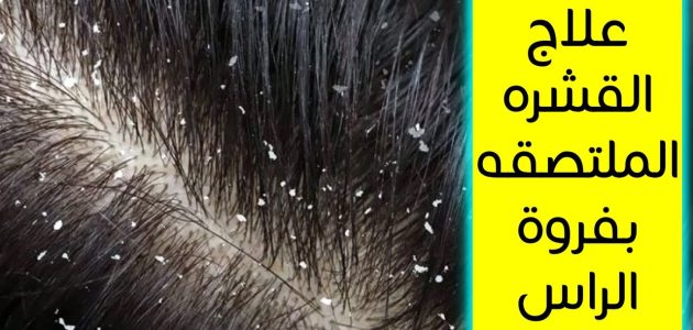 علاج القشرة الملتصقة بفروة الرأس قوي بطريقة طبيعية من أول مرة 1 علاج القشرة الملتصقة بفروة الرأس