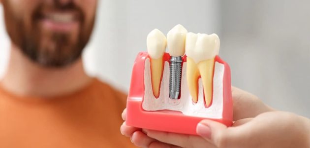 ما هو اسم افضل دكتور زراعة اسنان في مكة ورقم التواصل 1 اسم افضل دكتور زراعة اسنان في مكة
