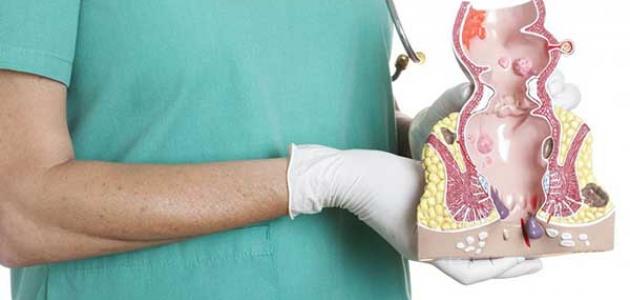 ما هي تجاربكم مع علاج البواسير وأسباب الإصابة بالبواسير 1 تجاربكم مع علاج البواسير