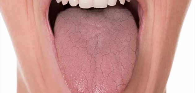 تجربتي مع جفاف الحلق وطرق التخلص منه وأسباب جفاف الحلق 1 تجربتي مع جفاف الحلق