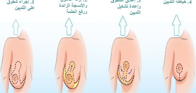 خطوات تصغير الثدي | 10 أشياء يجب معرفتها عن تصغير الثدي 1 خطوات تصغير الثدي