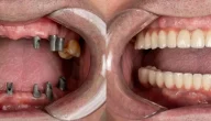 أفضل دكتور زراعة الأسنان الفورية في الدمام 2025