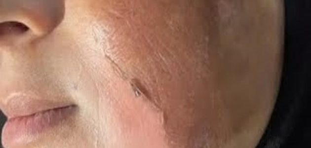 كيفية التقشير الكيميائي للوجه بالمنزل بخطوات سهلة وبسيطة 1 كيفية التقشير الكيميائي للوجه