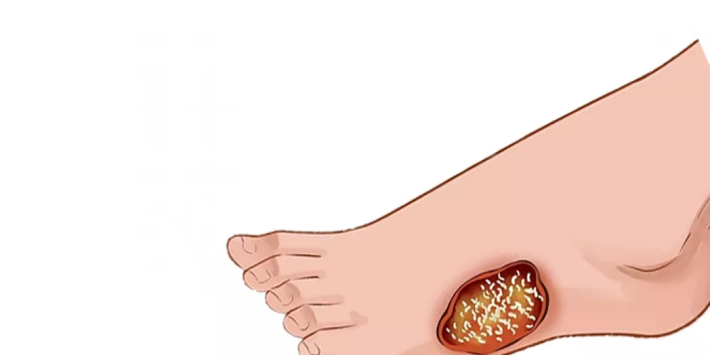 ما هو أكثر شيء يسبب الغرغرينا وأبرز الأعراض 1 ما هو أكثر شيء يسبب الغرغرينا